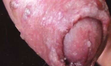 尖锐湿疣的症状图片