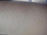 ���۲�֢״����ͼƬ