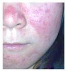 接触性皮炎治疗的注意事项