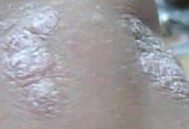 牛皮癣出现浮肿如何处理