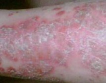 �����ţƤѢ���ٴ�֢״