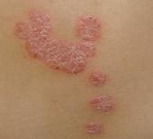 Ƥ���ָ��������أ�