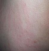 ������Ӧ��Ƥ�׵ı�����ʩ