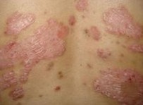 ţƤѢ��Ҫ��֢״����