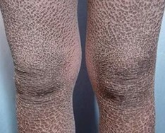 ���۲����µ��ۺ�֢