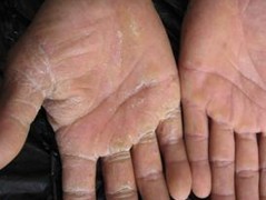 揭示手足癣的危害