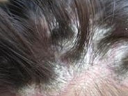 ͷ��ţƤѢ�ᷢ����ɢ��ԭ��