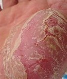 ţƤѢ����Ҫע����Щ����֢