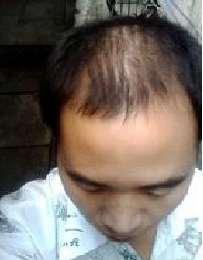 如何治疗脂溢性脱发