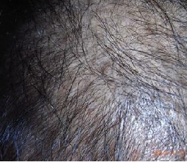 怎样进行脱发的治疗