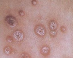 梅毒是如何传染的