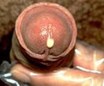 引起淋病的主要原因