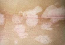 白癜风病因是什么