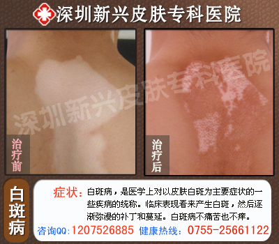 白癜风治疗前后对比