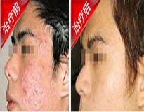 痤疮治疗效果对比