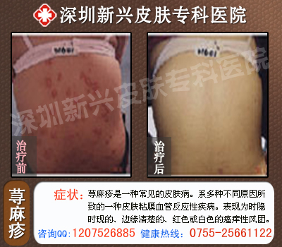 荨麻疹治疗前后对比