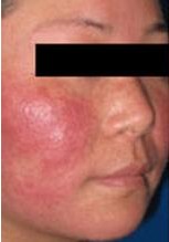 过敏性皮炎多久能好