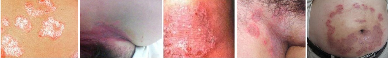 体癣症状是如何体现的